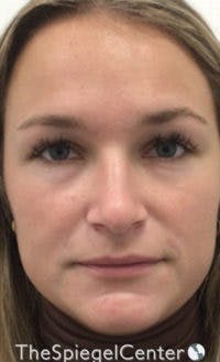 IPL / Intense Pulse Light Before & After Gallery - Patient 373506 - Image 1