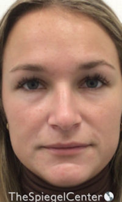 IPL / Intense Pulse Light Before & After Gallery - Patient 373506 - Image 1