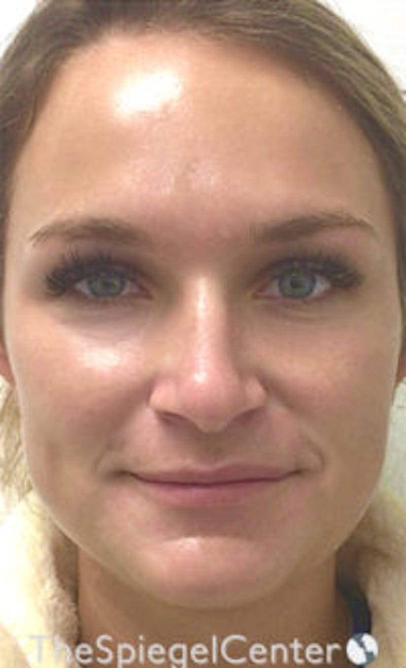 IPL / Intense Pulse Light Before & After Gallery - Patient 373506 - Image 2