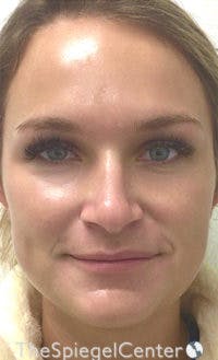 IPL / Intense Pulse Light Before & After Gallery - Patient 373506 - Image 2