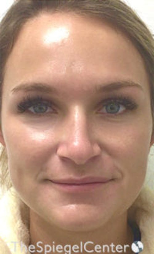 IPL / Intense Pulse Light Before & After Gallery - Patient 373506 - Image 2