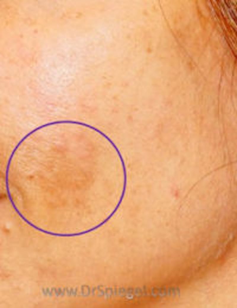 IPL / Intense Pulse Light Before & After Gallery - Patient 379375 - Image 1