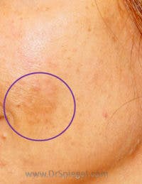 IPL / Intense Pulse Light Before & After Gallery - Patient 379375 - Image 1