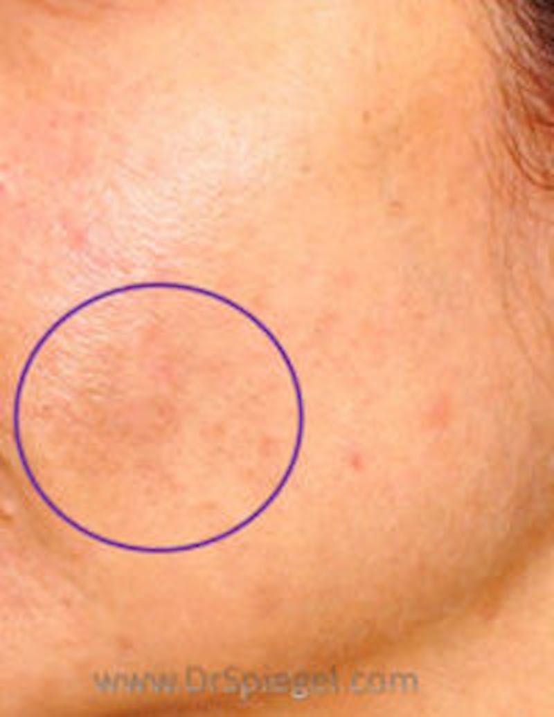 IPL / Intense Pulse Light Before & After Gallery - Patient 379375 - Image 2