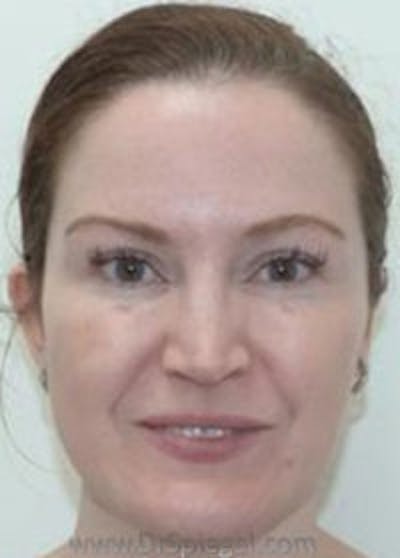 IPL / Intense Pulse Light Before & After Gallery - Patient 199405 - Image 1