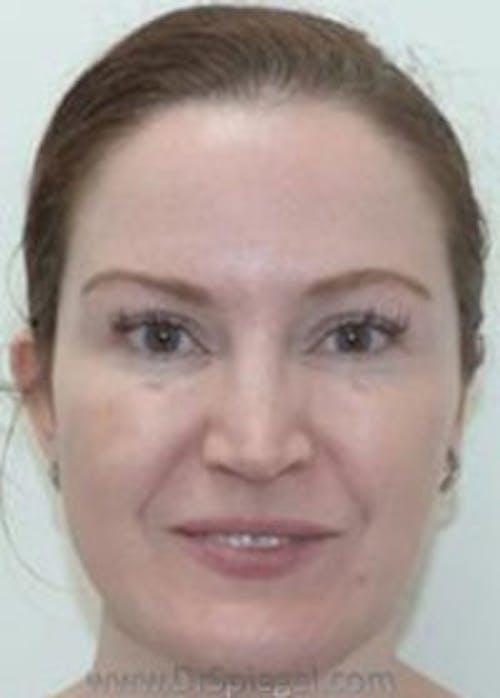 IPL / Intense Pulse Light Before & After Gallery - Patient 199405 - Image 1