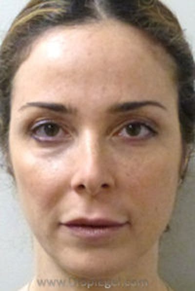 IPL / Intense Pulse Light Before & After Gallery - Patient 302474 - Image 1