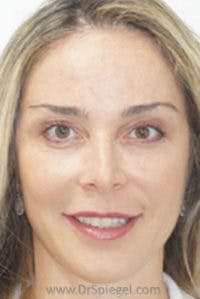 IPL / Intense Pulse Light Before & After Gallery - Patient 302474 - Image 2