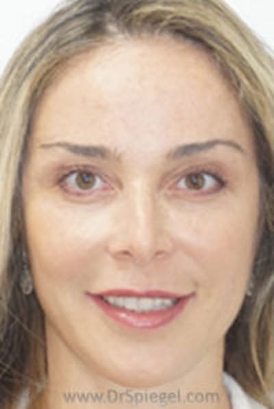 IPL / Intense Pulse Light Before & After Gallery - Patient 302474 - Image 2