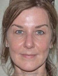 IPL / Intense Pulse Light Before & After Gallery - Patient 198860 - Image 1