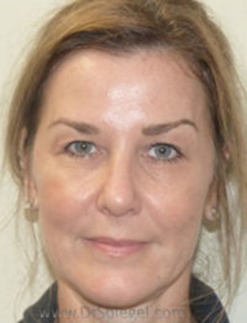 IPL / Intense Pulse Light Before & After Gallery - Patient 198860 - Image 2