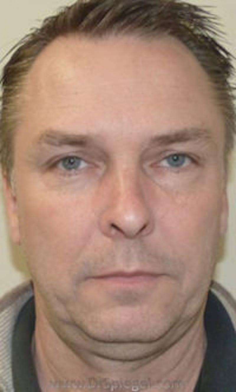 Kybella Before & After Gallery - Patient 424563 - Image 1