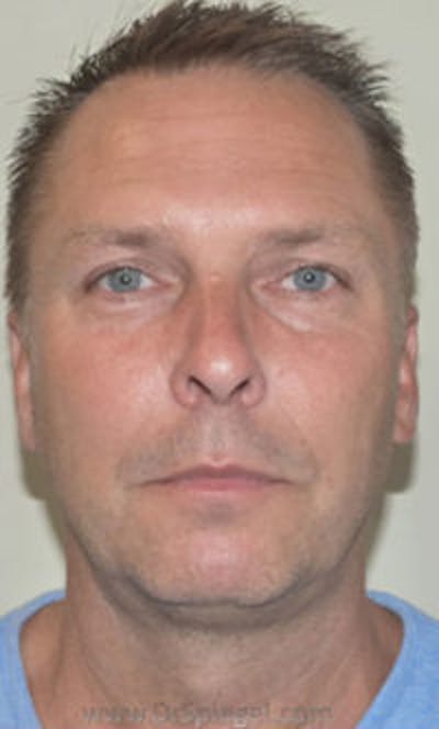 Kybella Before & After Gallery - Patient 424563 - Image 2