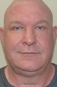 Kybella Before & After Gallery - Patient 245799 - Image 1