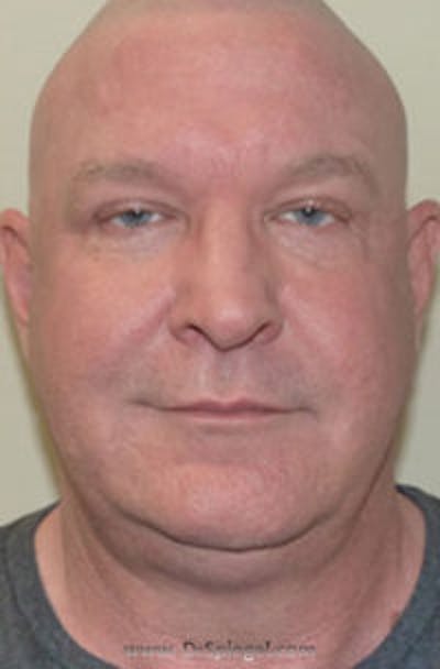 Kybella Before & After Gallery - Patient 245799 - Image 1