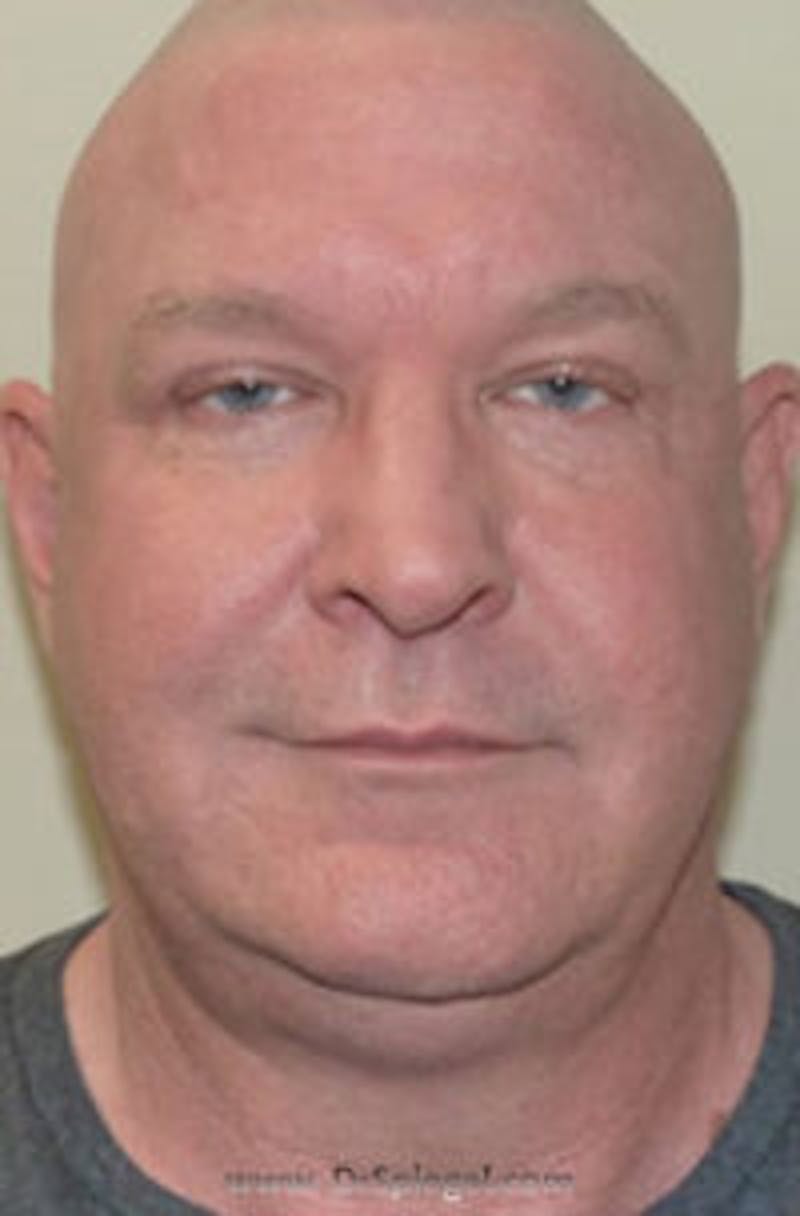 Kybella Before & After Gallery - Patient 245799 - Image 1