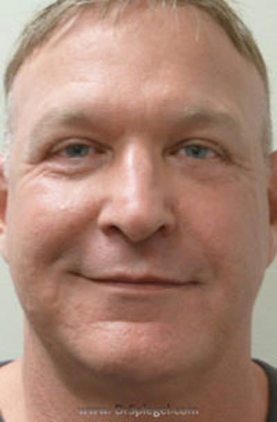 Kybella Before & After Gallery - Patient 245799 - Image 2