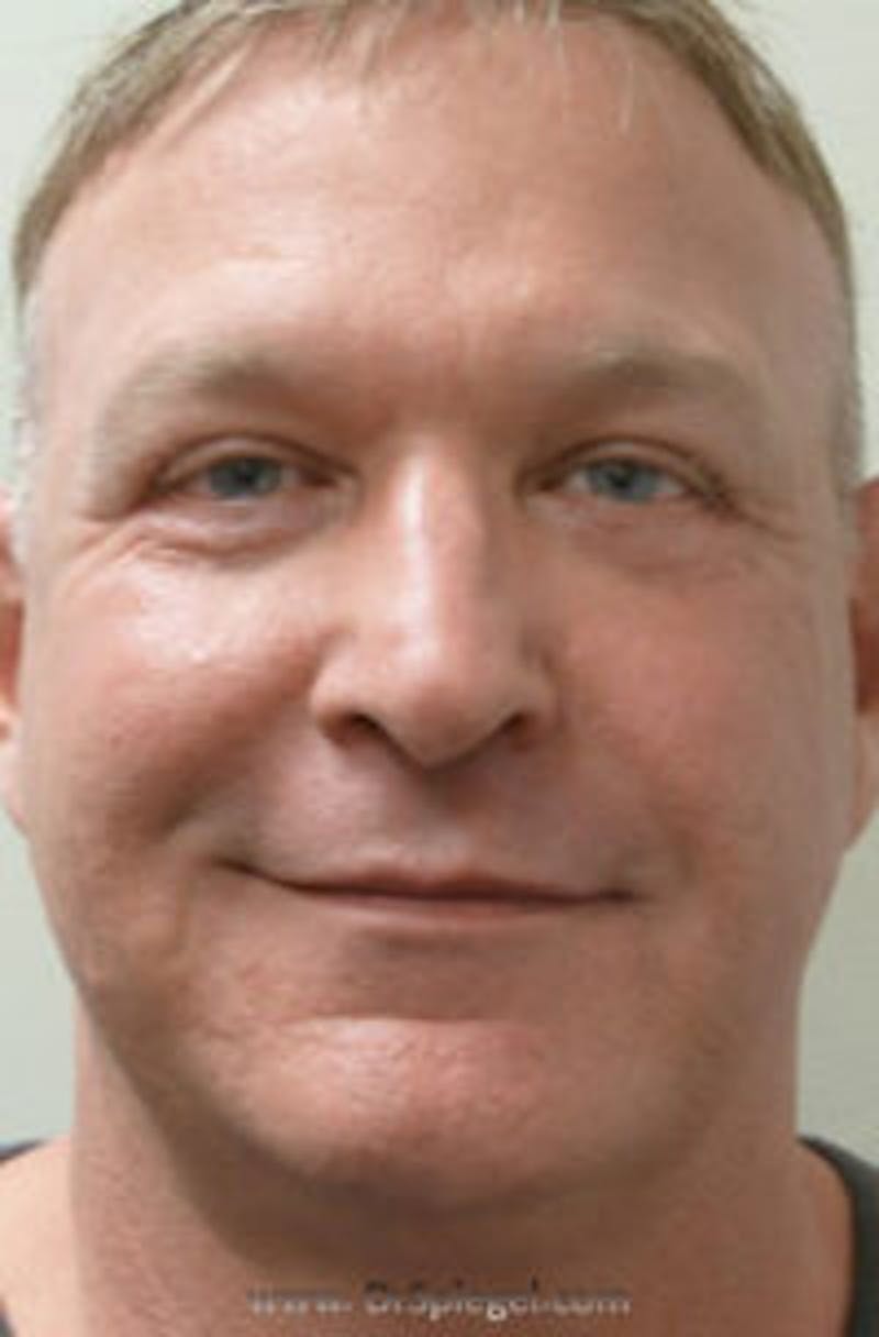 Kybella Before & After Gallery - Patient 245799 - Image 2