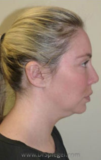 Kybella Before & After Gallery - Patient 333749 - Image 1