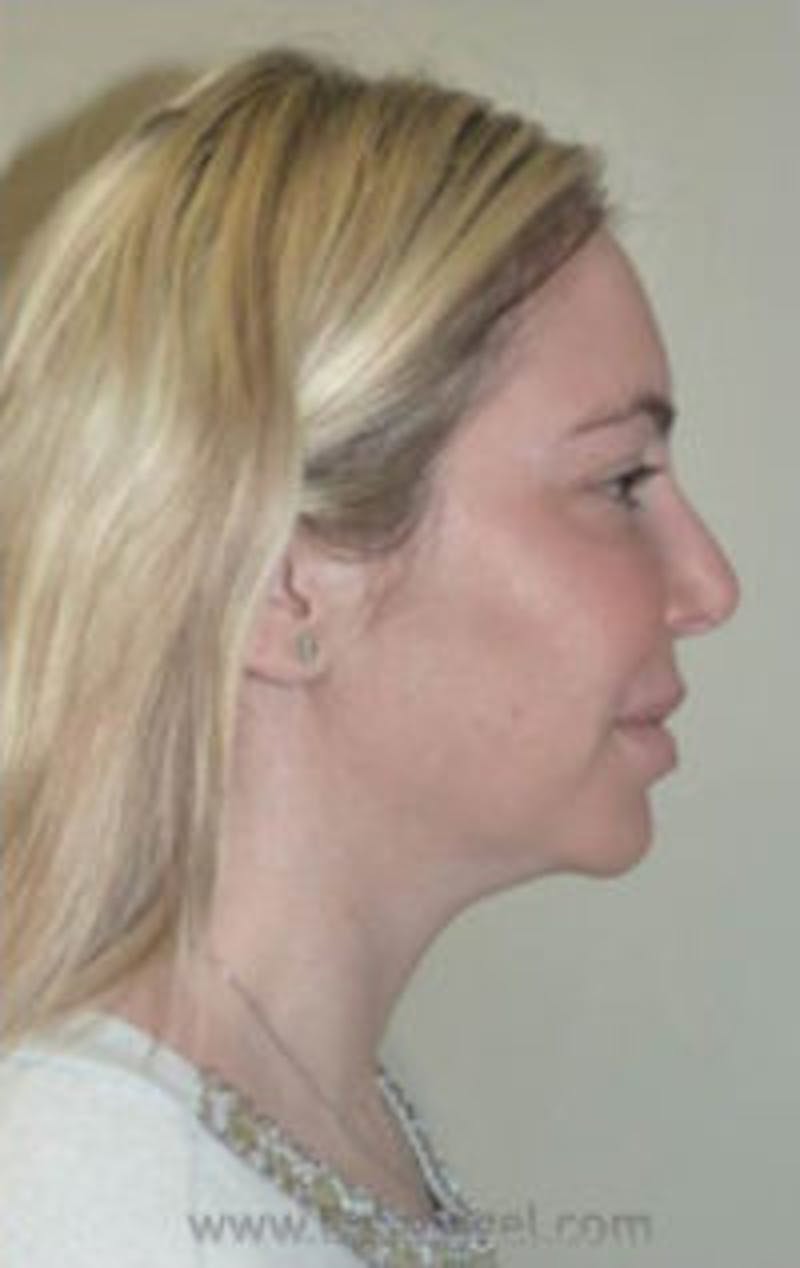 Kybella Before & After Gallery - Patient 333749 - Image 2