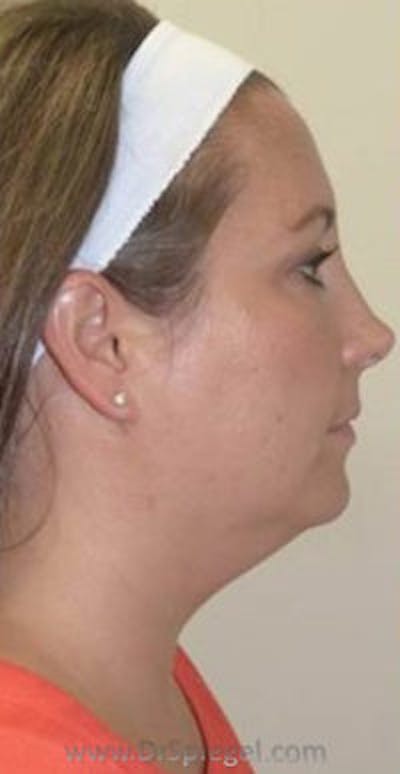 Kybella Before & After Gallery - Patient 689786 - Image 1