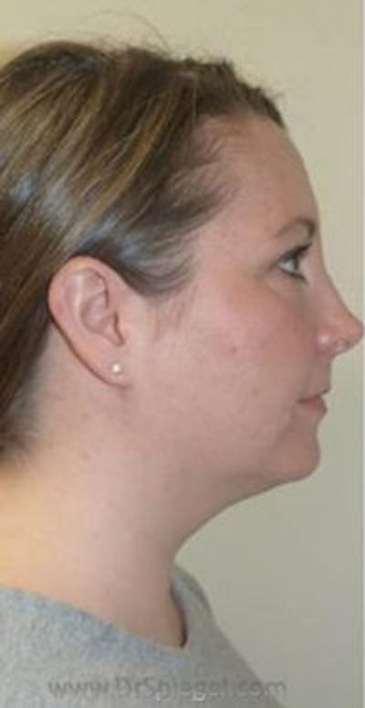 Kybella Before & After Gallery - Patient 689786 - Image 2