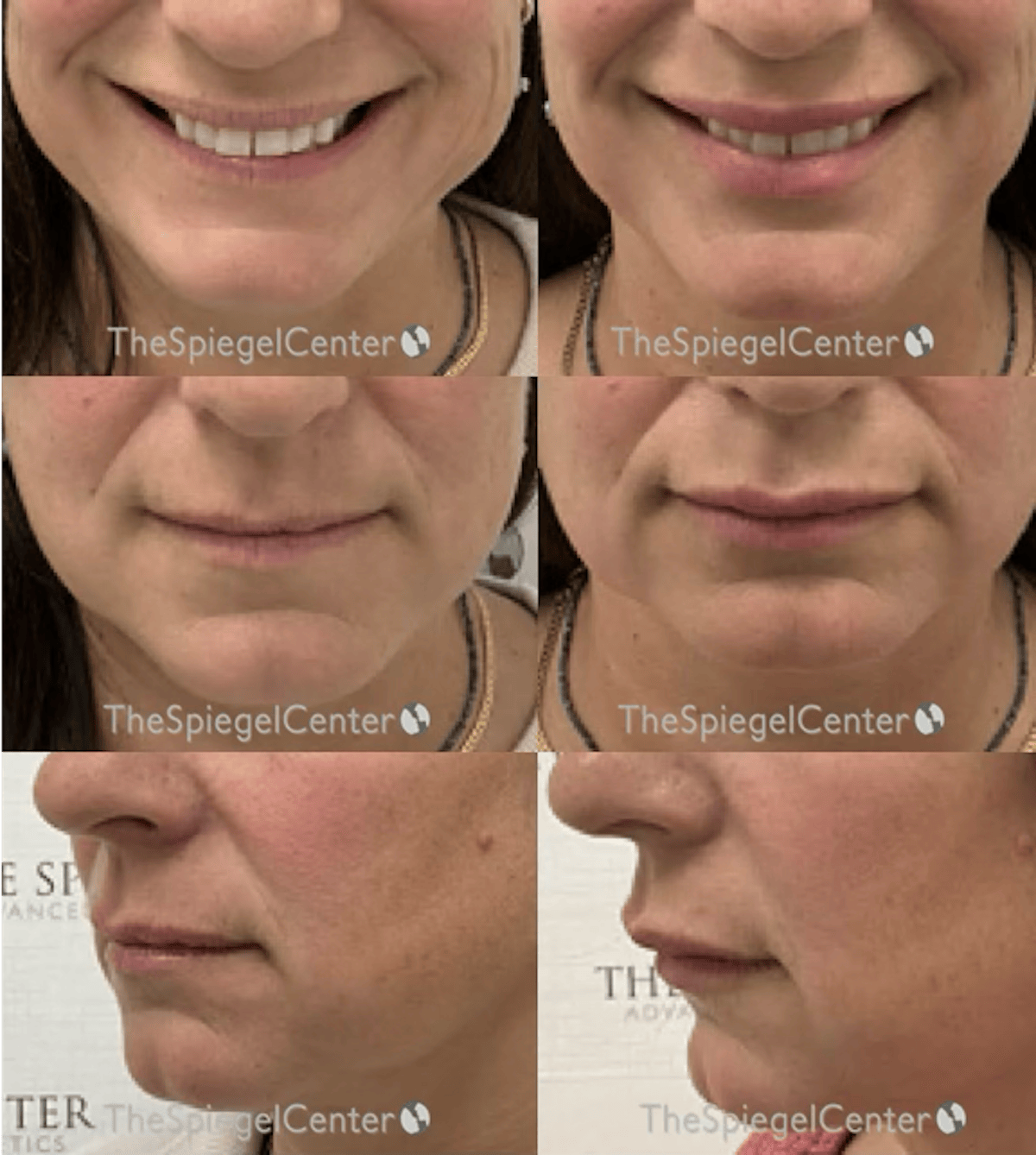 Lip Filler Before & After Gallery - Patient 267350 - Image 1