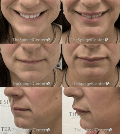 Lip Filler Before & After Gallery - Patient 267350 - Image 1