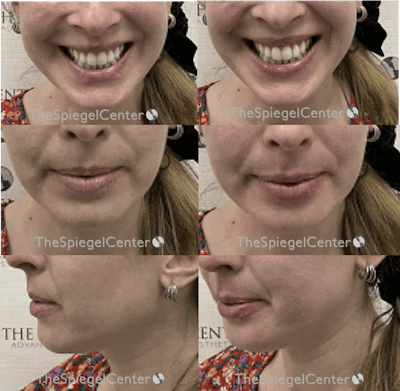 Lip Filler Before & After Gallery - Patient 367634 - Image 1