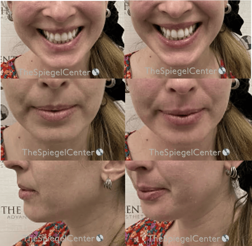 Lip Filler Before & After Gallery - Patient 367634 - Image 1