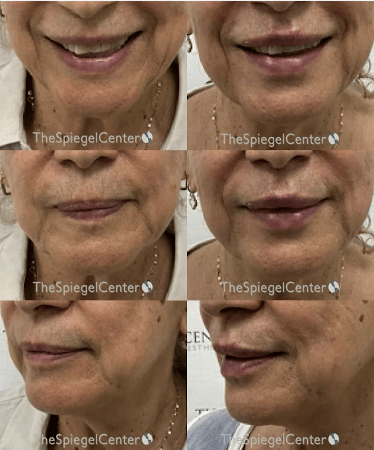 Lip Filler Before & After Gallery - Patient 258134 - Image 1