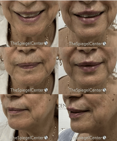 Lip Filler Before & After Gallery - Patient 258134 - Image 1