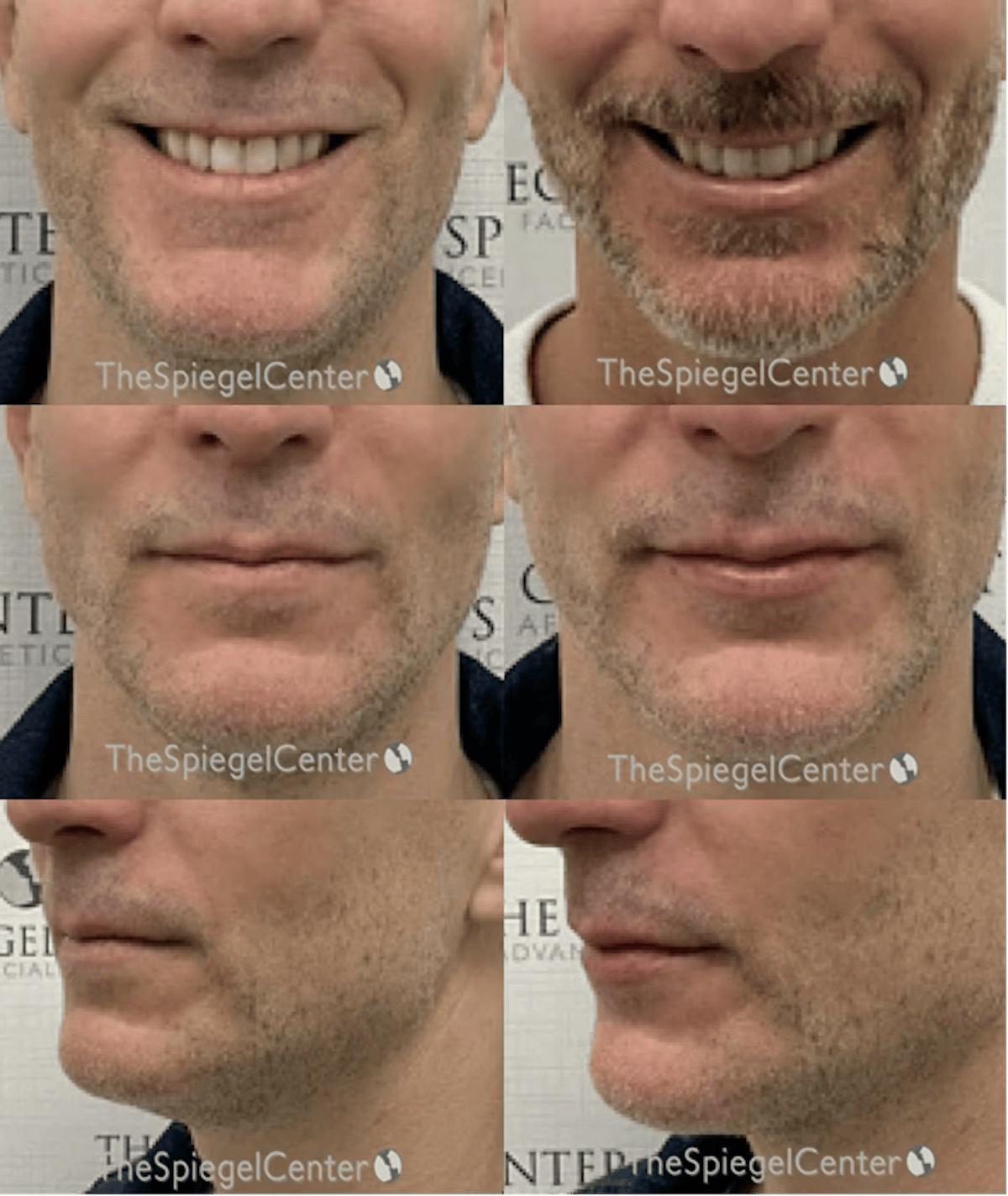 Lip Filler Before & After Gallery - Patient 212499 - Image 1