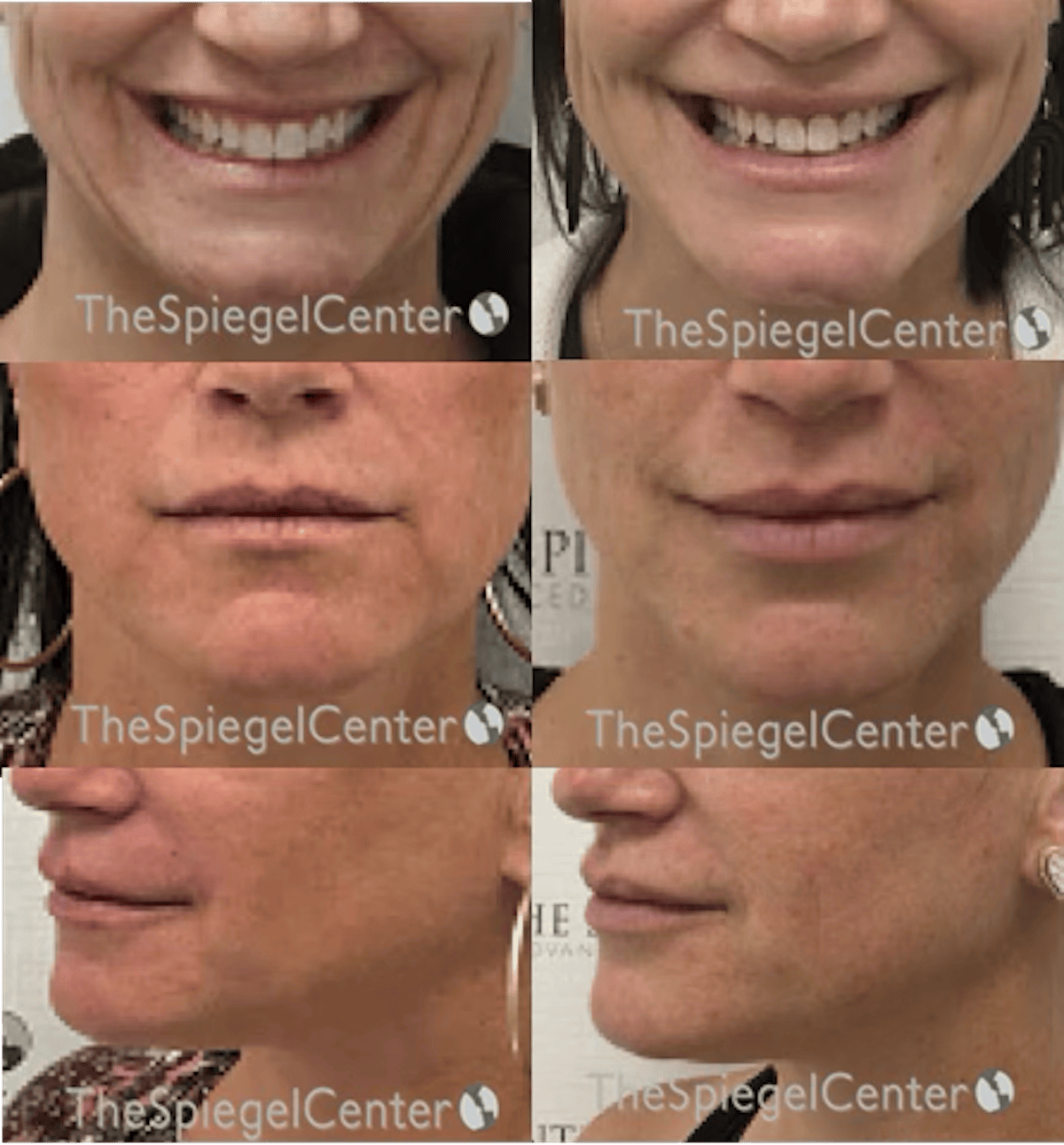 Lip Filler Before & After Gallery - Patient 183254 - Image 1