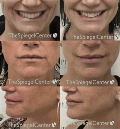 Lip Filler Before & After Gallery - Patient 183254 - Image 1