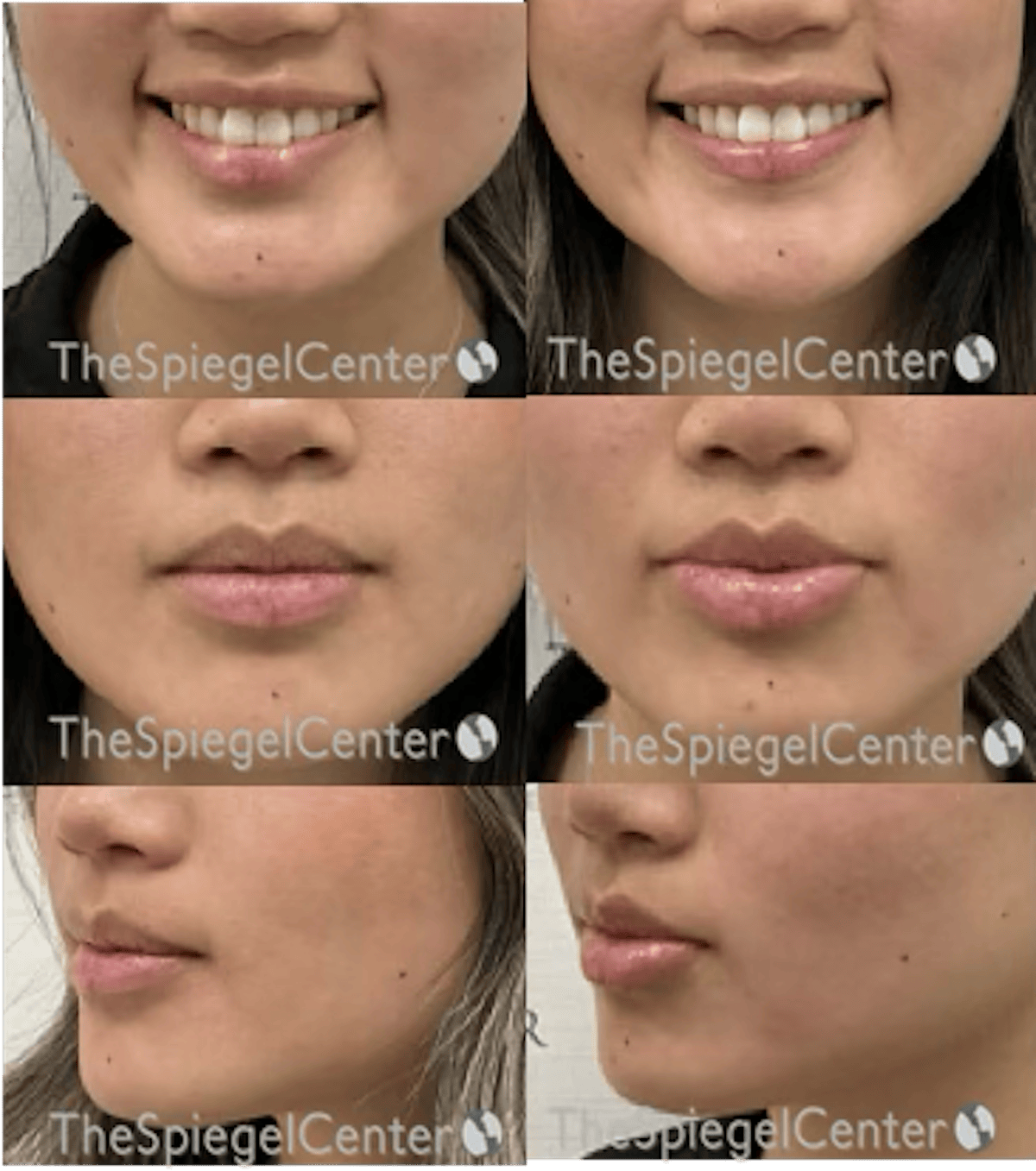 Lip Filler Before & After Gallery - Patient 417906 - Image 1