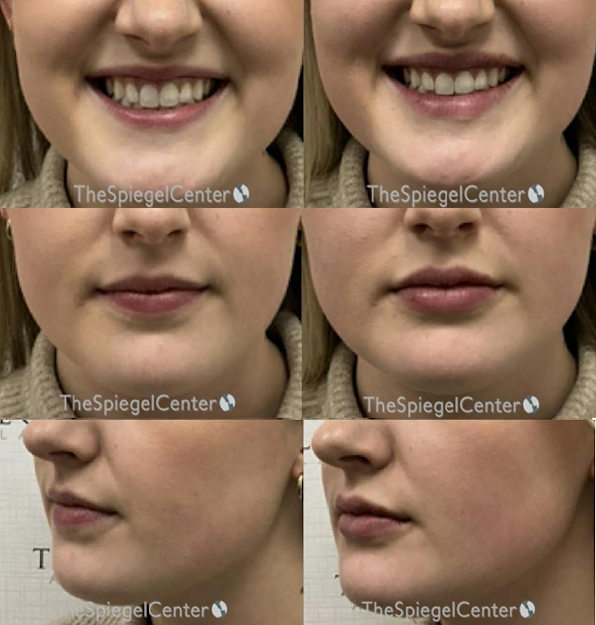 Lip Filler Before & After Gallery - Patient 208389 - Image 1