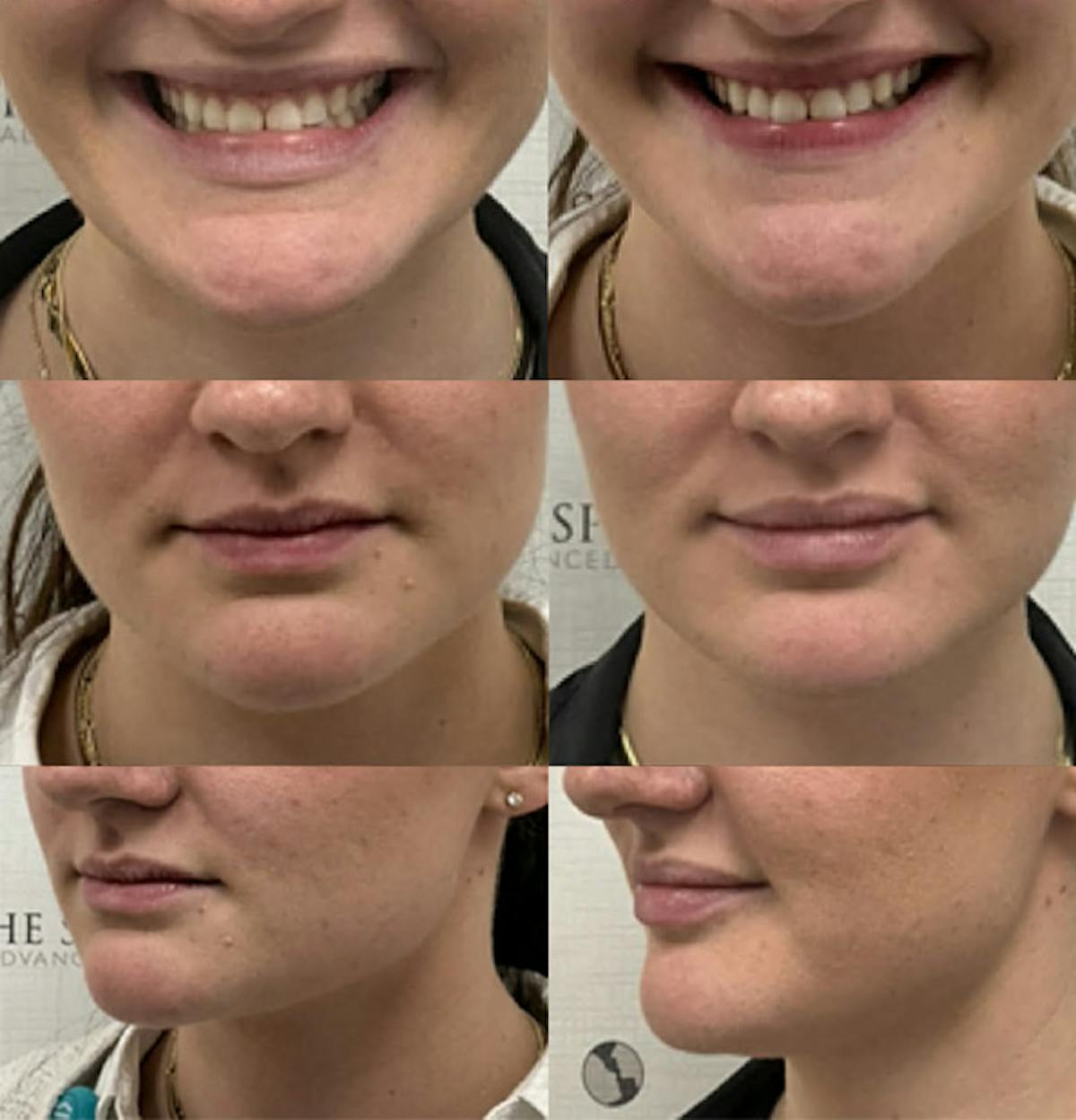 Lip Filler Before & After Gallery - Patient 110941 - Image 1