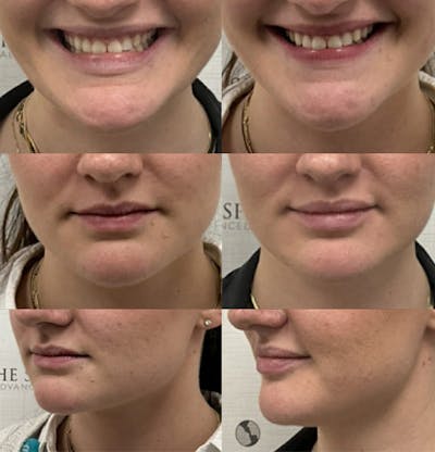 Lip Filler Before & After Gallery - Patient 110941 - Image 1