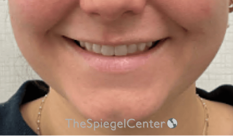 Lip Filler Before & After Gallery - Patient 487275 - Image 1