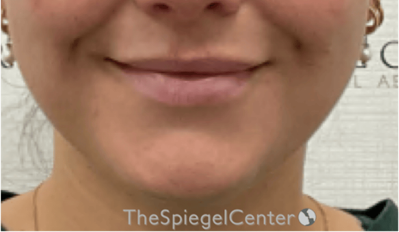 Lip Filler Before & After Gallery - Patient 487275 - Image 2