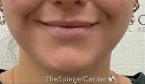Lip Filler Before & After Gallery - Patient 487275 - Image 2