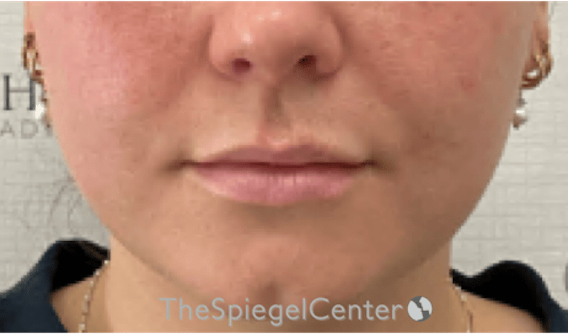 Lip Filler Before & After Gallery - Patient 487275 - Image 3