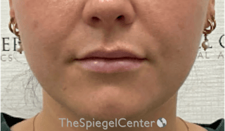 Lip Filler Before & After Gallery - Patient 487275 - Image 4