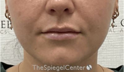 Lip Filler Before & After Gallery - Patient 487275 - Image 4