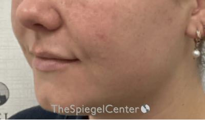 Lip Filler Before & After Gallery - Patient 487275 - Image 5