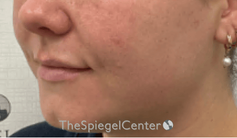 Lip Filler Before & After Gallery - Patient 487275 - Image 5
