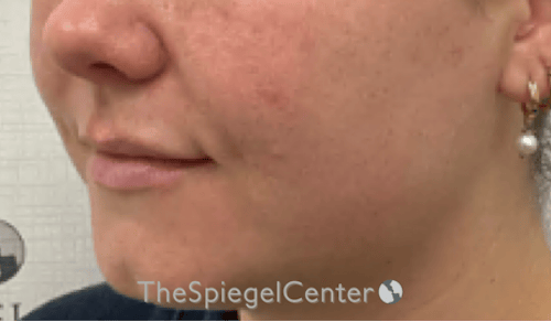Lip Filler Before & After Gallery - Patient 487275 - Image 5