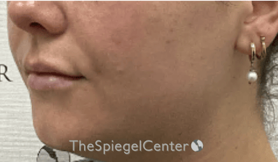 Lip Filler Before & After Gallery - Patient 487275 - Image 6