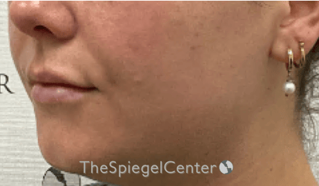 Lip Filler Before & After Gallery - Patient 487275 - Image 6